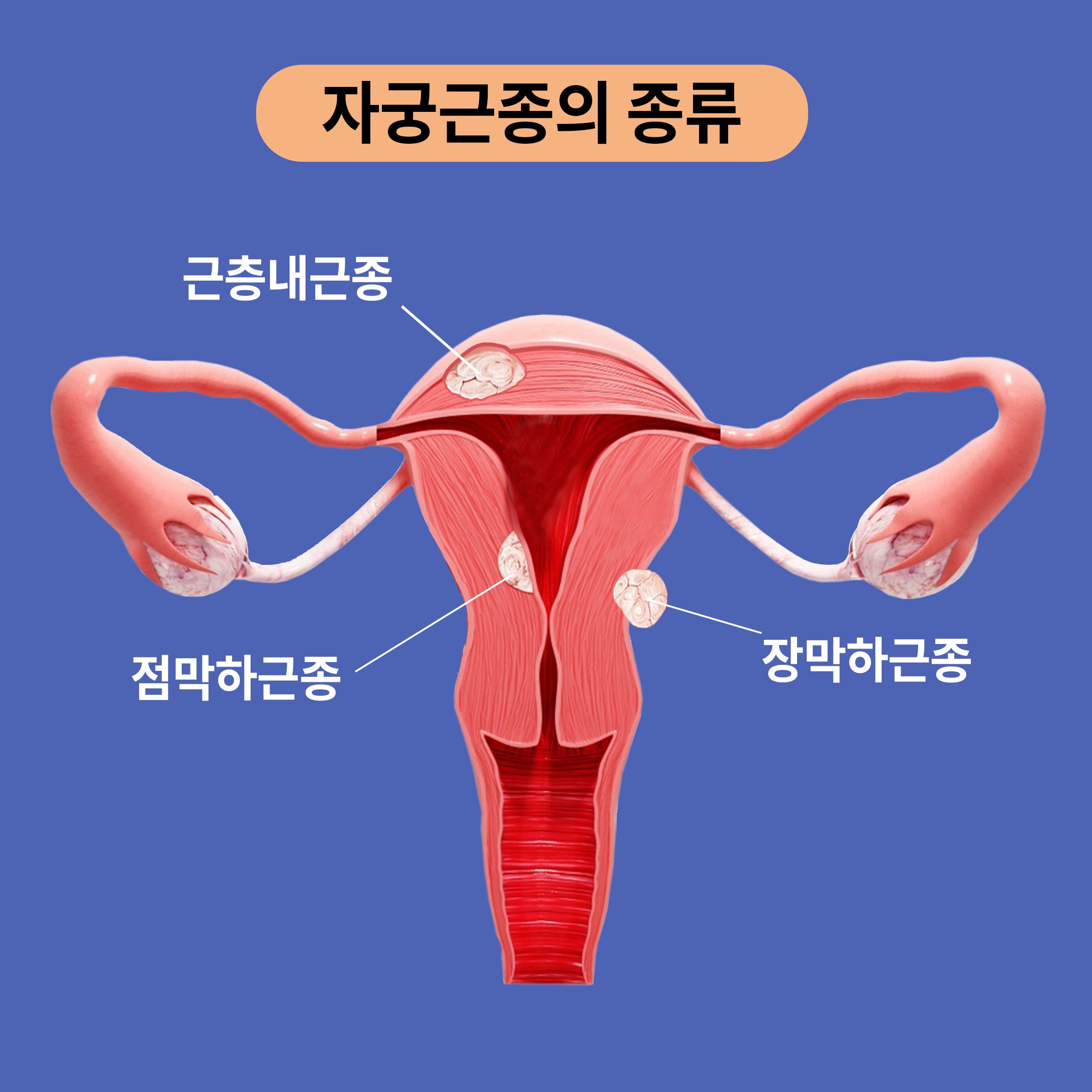 자궁근종, 무엇인가요?