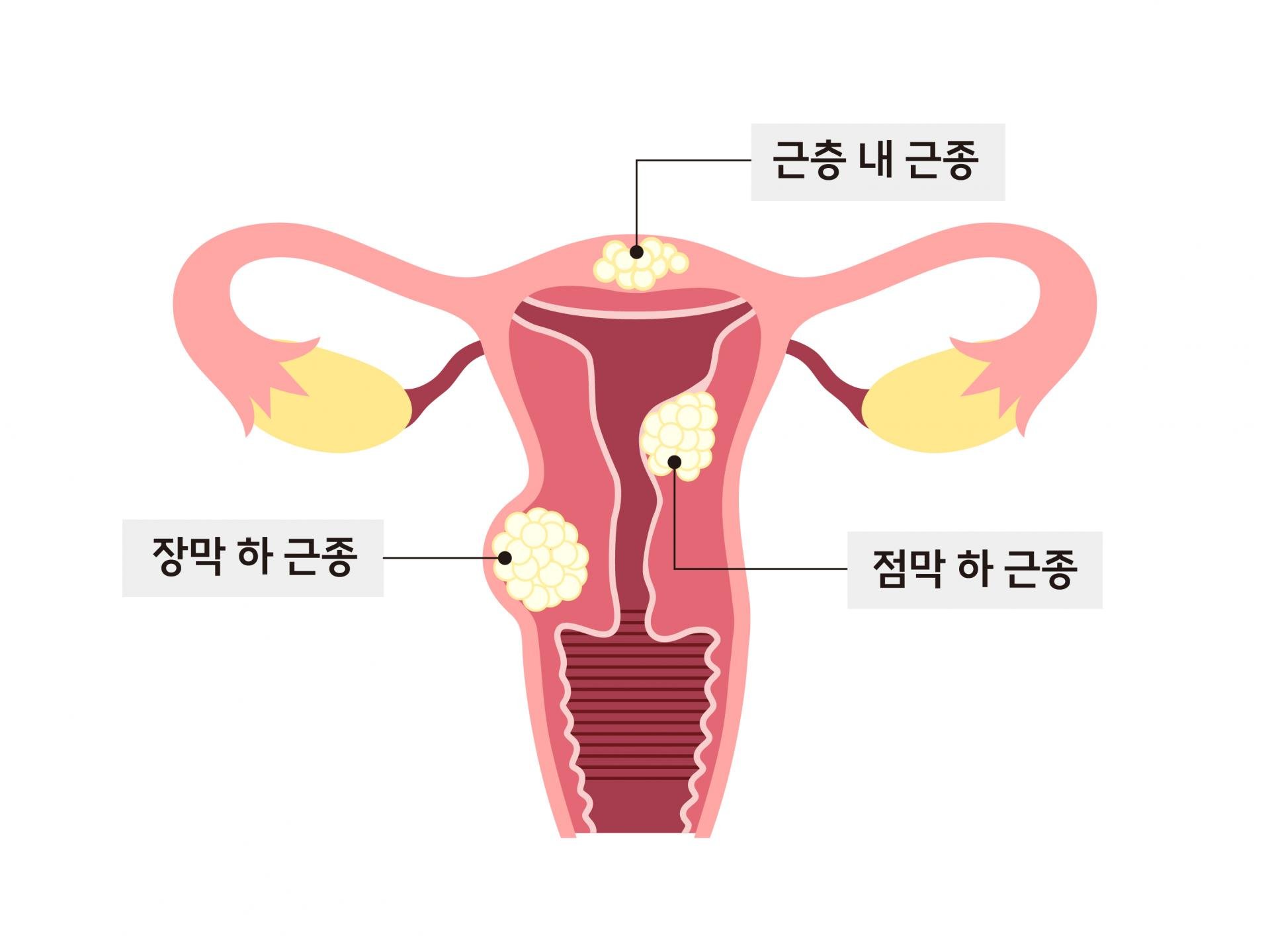 증상이 없는 자궁근종의 위험성