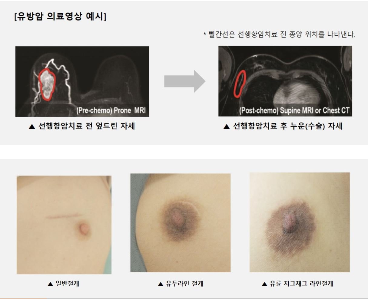 유방암 투병 여정을 공개하며