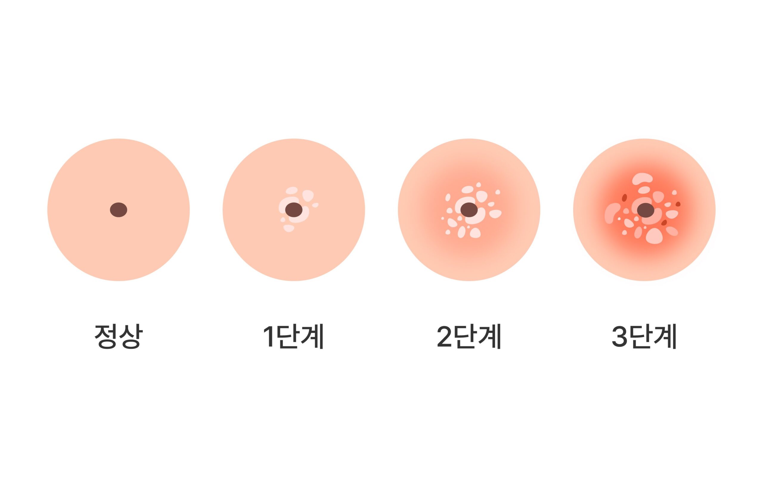 자궁경부이형성증이란 무엇인가?