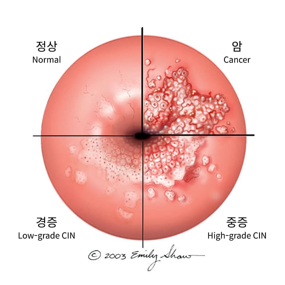 자궁경부이형성증의 위험성과 대처 방법